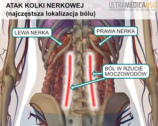 Kamica nerkowa - typowa lokalizacja bólu w przebiegu kolki nerkowej
