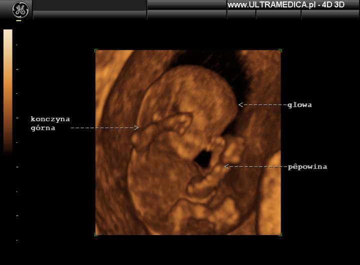 USG ciąży do 10 tygodnia Kraków