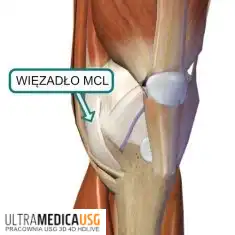 MCL kolana - leczenie uszkodzonego więzadła