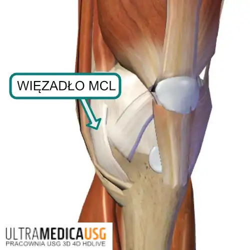 MCL kolana – leczenie uszkodzonego więzadła, Kraków