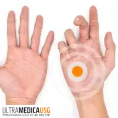 Choroba Dupuytrena - przykurcz rozcięgna dłoniowego
