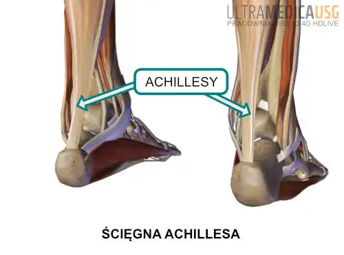 Ścięgno Achillesa a bieganie