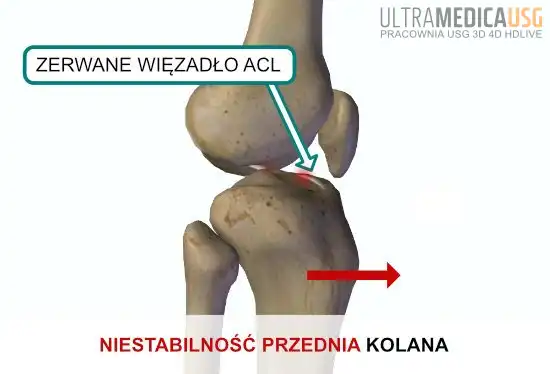 Zerwane więzadło ACL i niestabilność przednia kolana