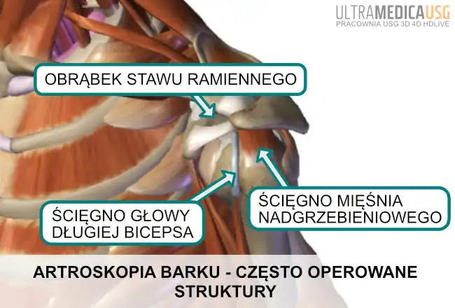 Artroskopia barku - często operowane struktury