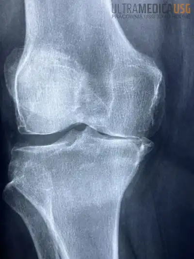Wskazania do endoprotezy kolana - zwyrodnienie przedziału przyśrodkowego