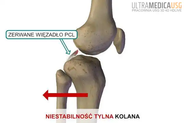 Zerwane więzadło PCL i niestabilność tylna kolana