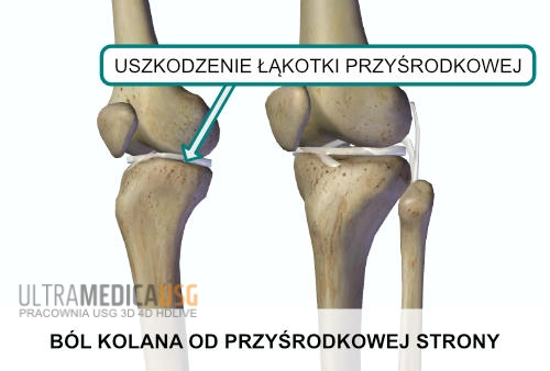 Ból stawu kolana od przyśrodkowej strony - uszkodzenie łąkotki przyśrodkowej