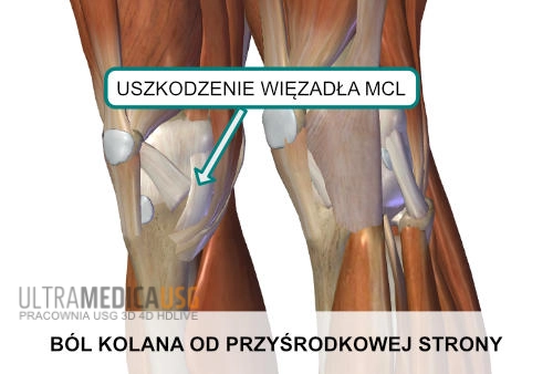 Ból kolana od przyśrodkowej strony - uszkodzenie więzadła MCL