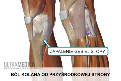 Ból kolana od przyśrodkowej strony - zapalenie gęsiej stopy ścięgnistej