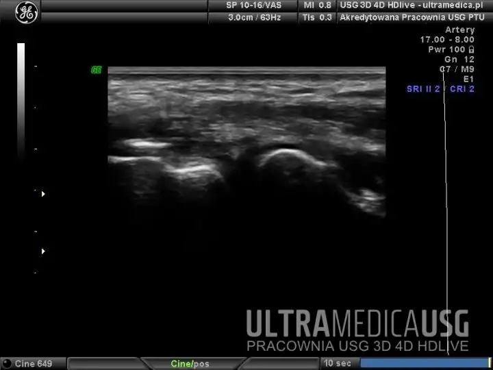 USG 3D 4D Podanie leku - Przykład zabiegu podania leku w obszar uszkodzenia w obrębie przyczepu wspólnego mięśni prostowników przedramienia