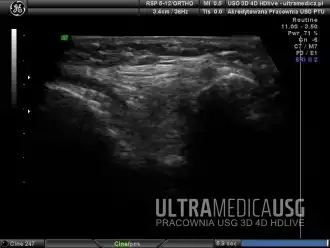 Badanie USG Kraków: staw kolanowy - więzadło krzyżowe przednie (zobrazowane w części środkowej)