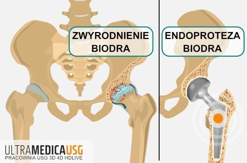 Zaawansowane zwyrodnienie biodra jako wskazanie do endoprotezy biodra