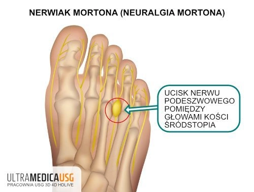Nerwiak Mortona, neuralgia Mortona - ucisk nerwu podeszwowego