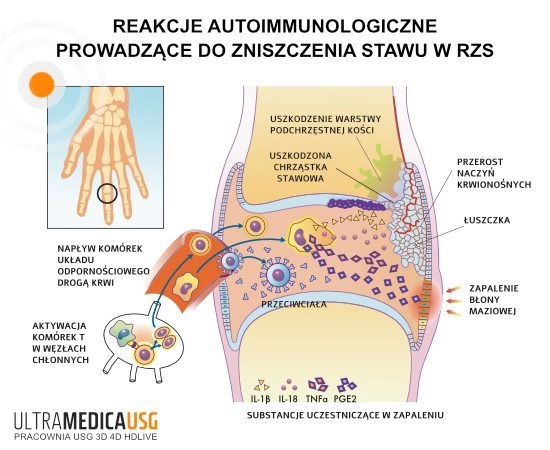 RZS - reakcje autoimmunologiczne wyzwalające zapalenie stawu
