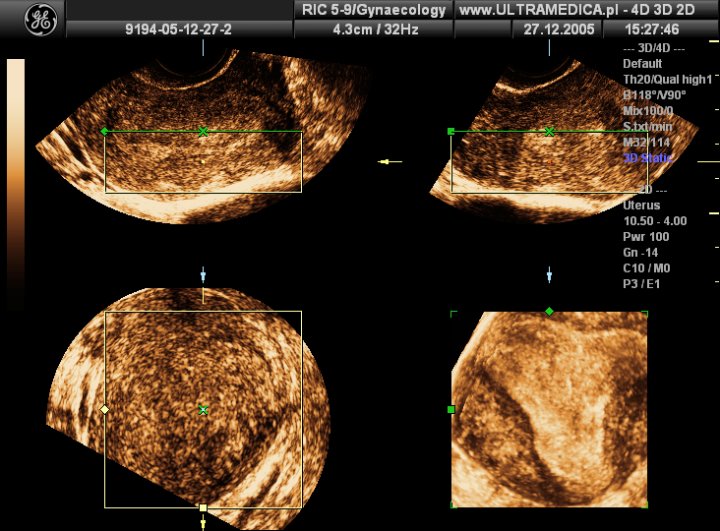 Precyzyjne USG ginekologiczne, dopochwowe, Kraków