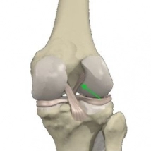 Staw kolanowy - Więzadlo krzyżowe przednie (część środkowa)