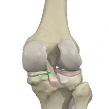 Staw kolanowy - Więzadło krzyżowe tylne - obraz w opcji B